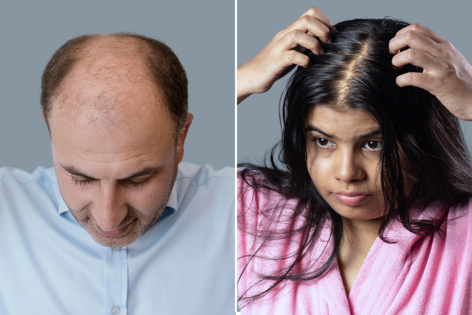 male pattern baldness female pattern baldness
