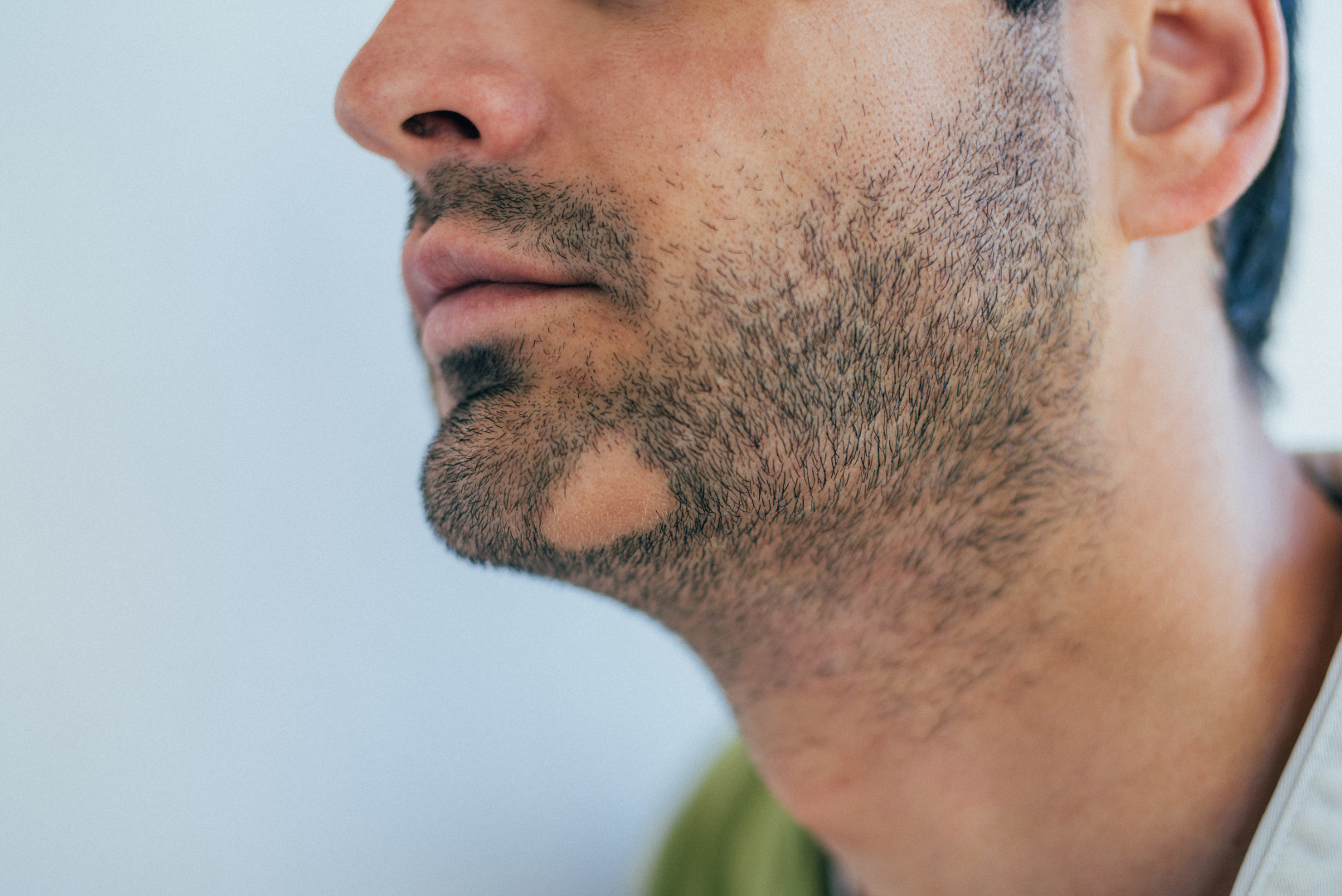 hair and scalp alopecia face alopecia aereata