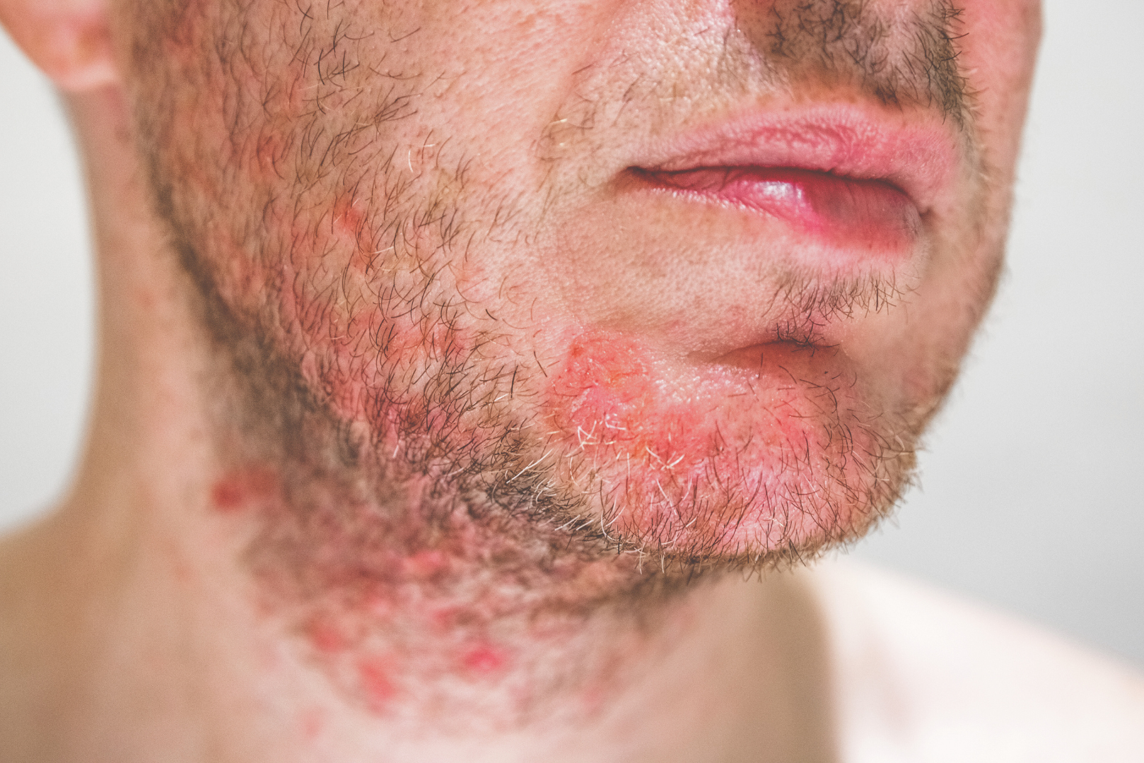 hair and scalp seborrheic dermatitis face